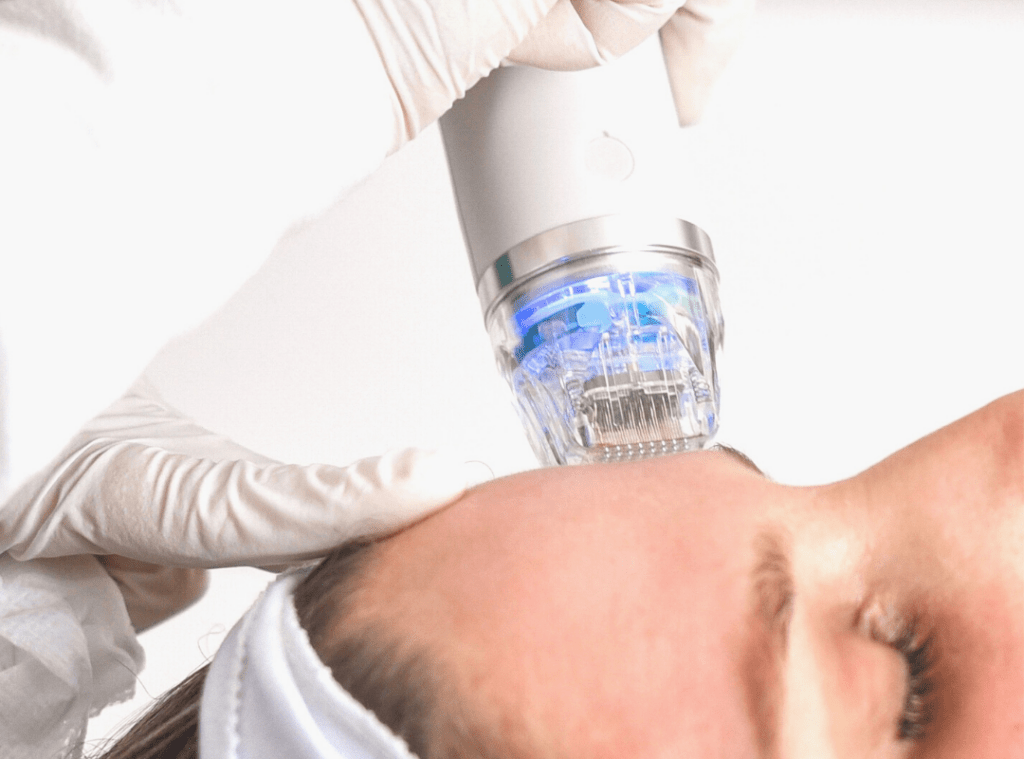 RF microneedling for Pepfactor infusion