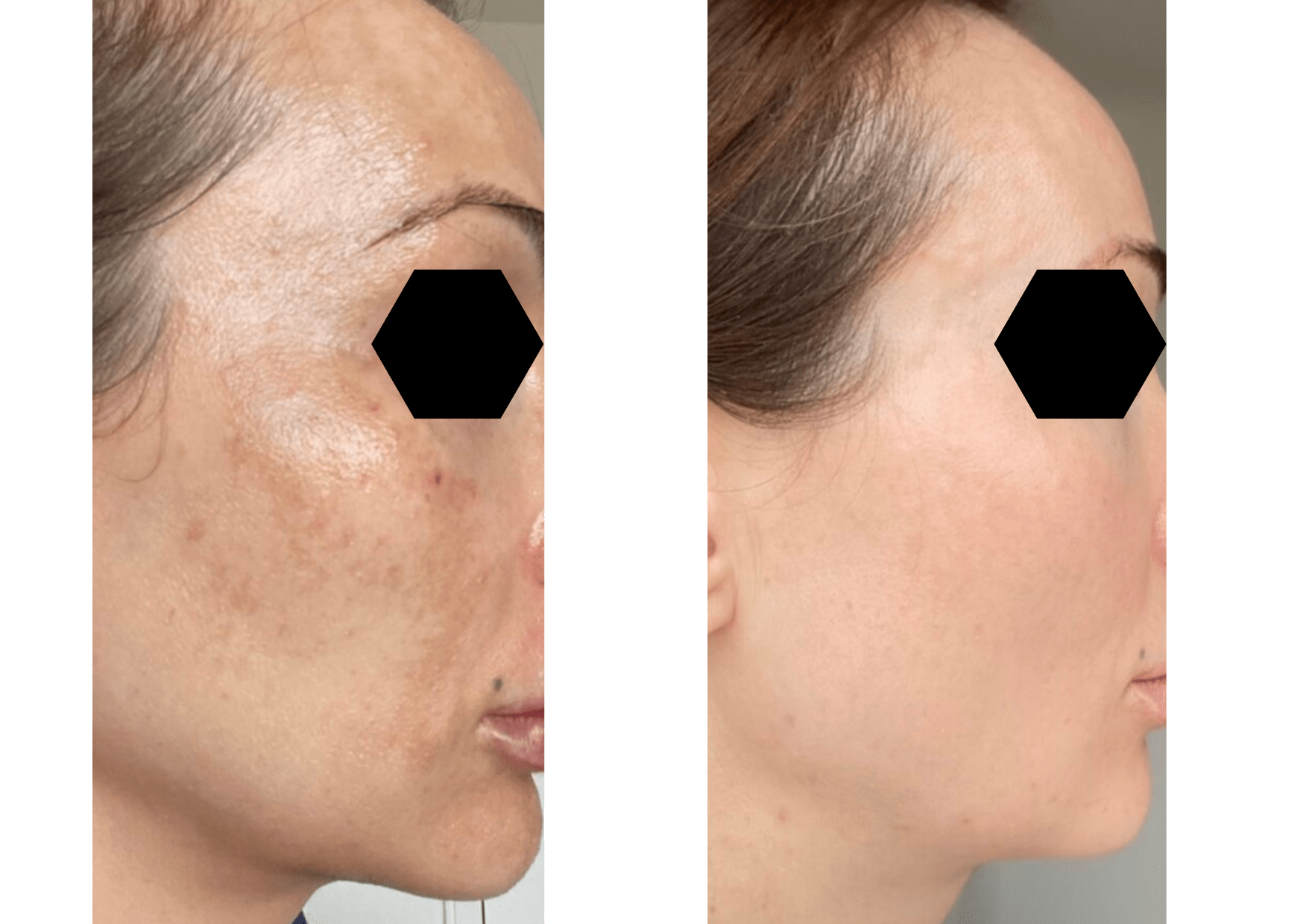 Cosmelan Facial Peel