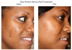 benefits of chemical peels