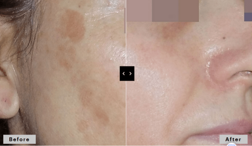 cosmelan peel results