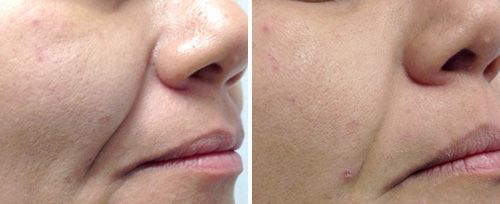 skin tightening treatment