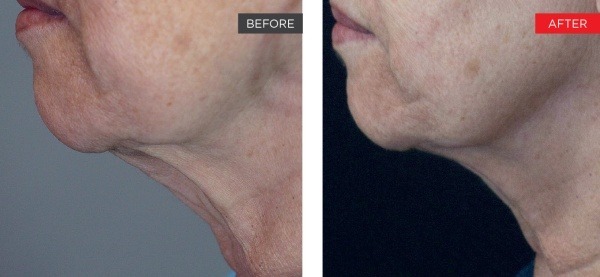 skin tightening treatment