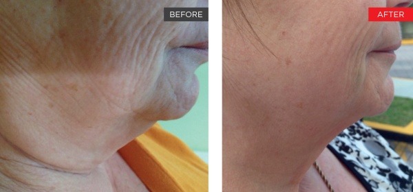 skin tightening Treatment