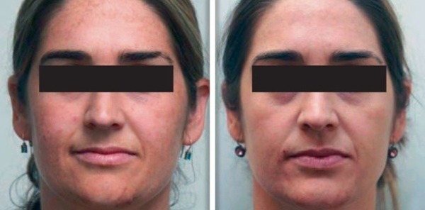 laser pigmentation removal