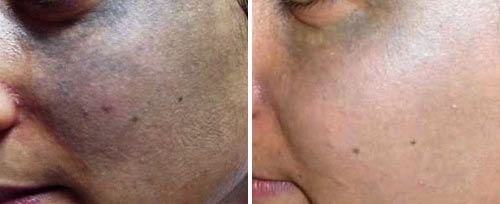 laser pigmentation removal