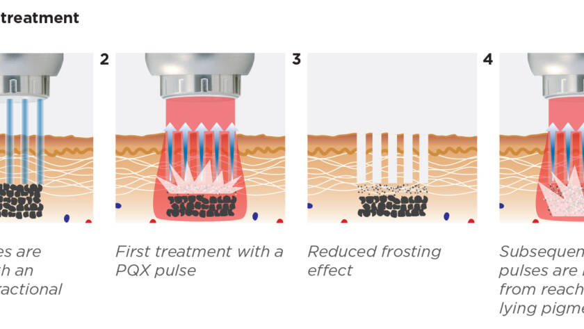 laser pigmentation removal