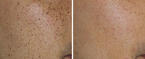 laser pigmentation removal