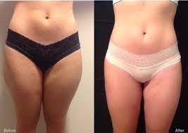 Non-Invasive Body Contouring Treatment