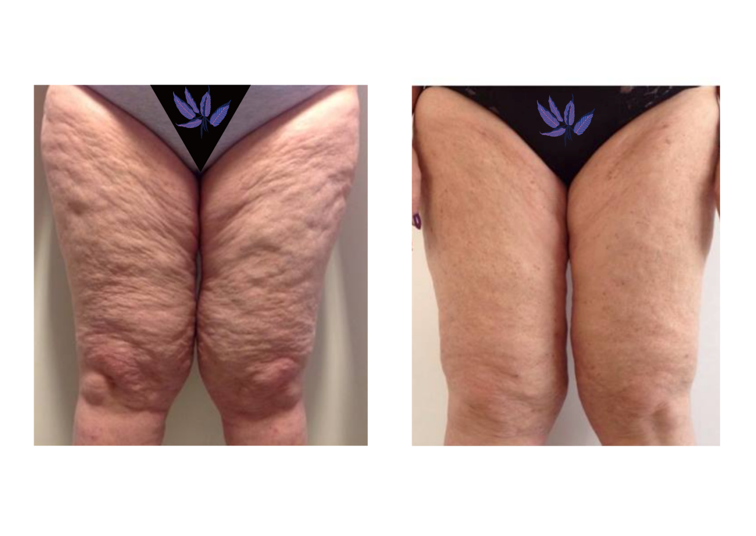 Non Invasive Body Contouring Tight Skin without Surgery