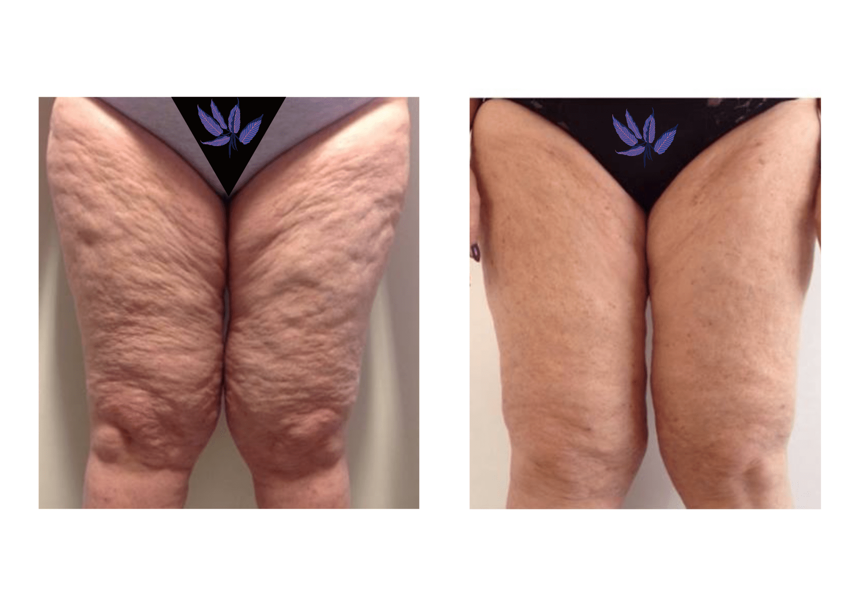 Non Invasive Body Contouring: Tight Skin without Surgery - En Sante Clinic  and Medical Spa