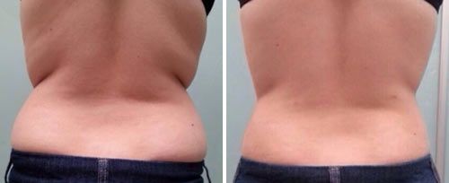 What is non-invasive body contouring? Bare Beauty Spatique