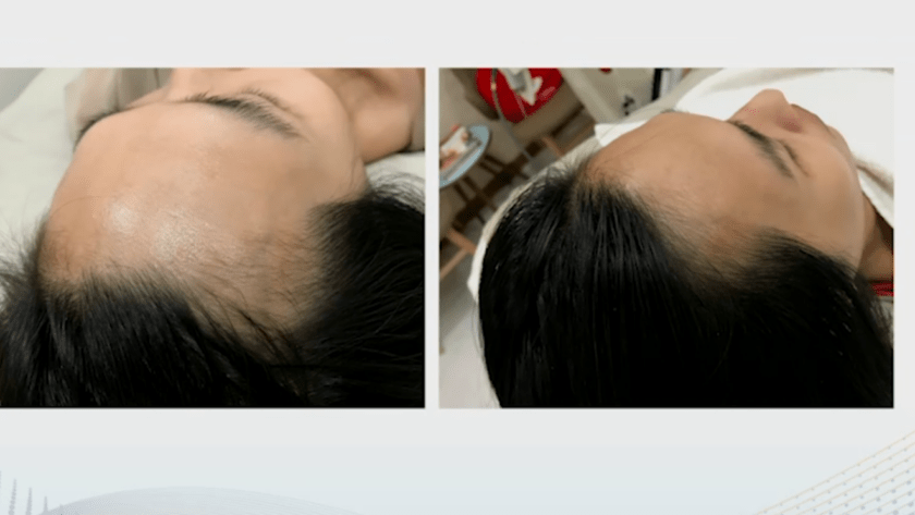 prp for hair loss