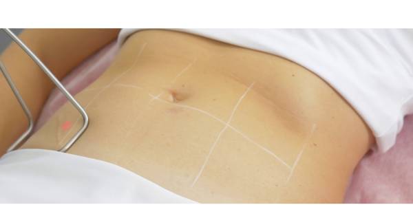 Fotona Tight Sculpting