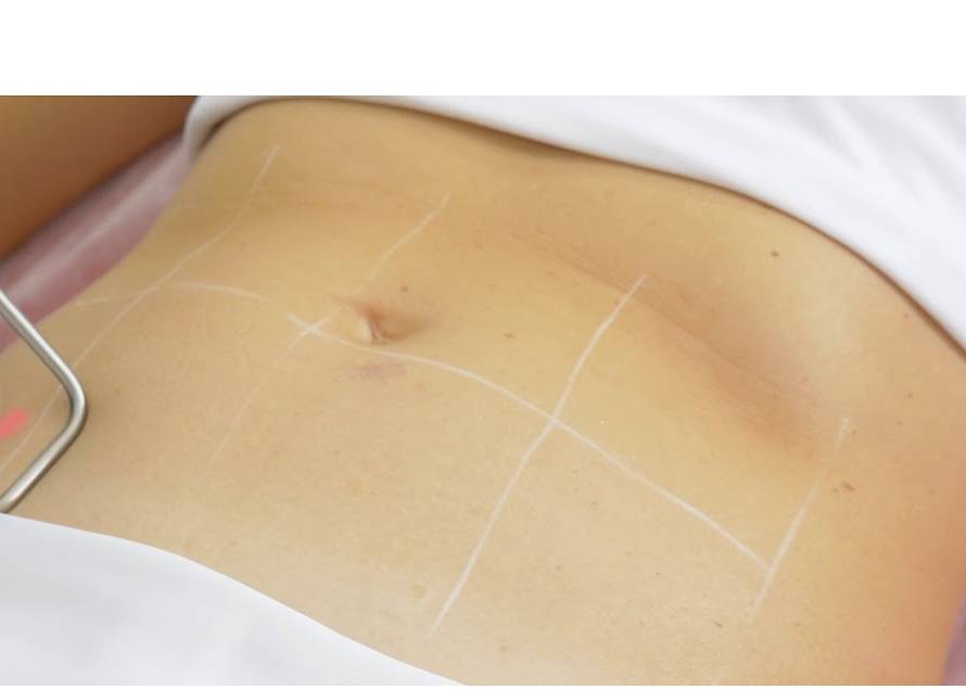 Fotona Tight Sculpting