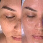 hydrafacial for boosting collagen