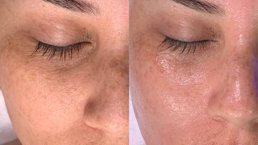 hydrafacial for boosting collagen