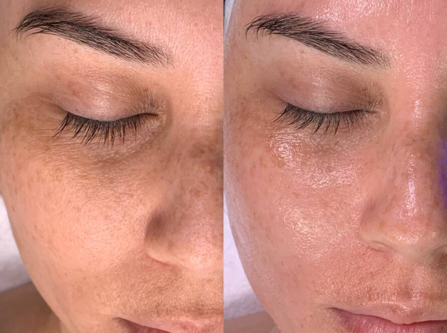 hydrafacial for boosting collagen