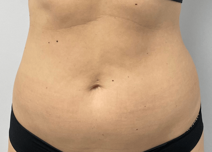 Laser lipo before