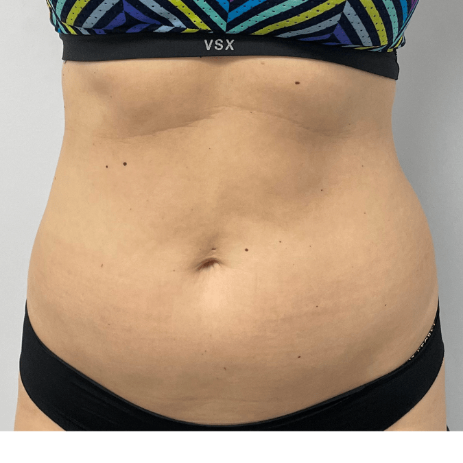 Belly Fat Redution Tysons Corner VA Before