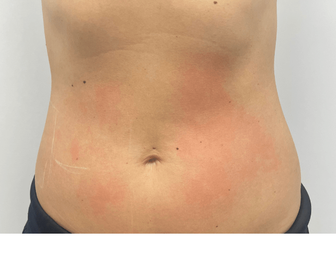 laser lipo after
