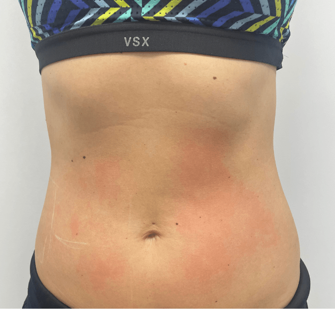 laser lipo after