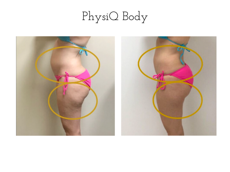 2.PhysiQ Body before and after