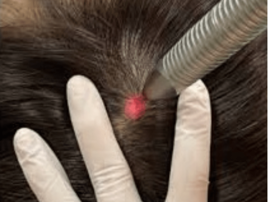 Best treatment for hair loss