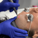 Laser skin resurfacing