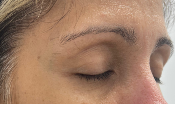 Eye Lift