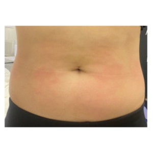 Fotona Tightsculpting belly after