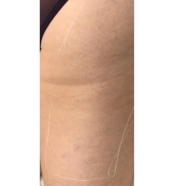 Laser Skin tightening thigh before picture e1696354322654