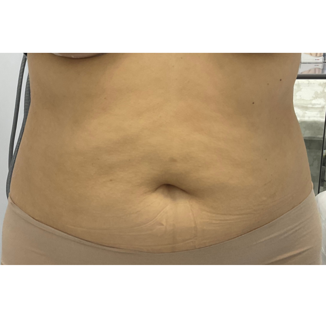 Non Invasive Body Contouring: Tight Skin without Surgery - En Sante Clinic  and Medical Spa