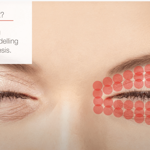 Fotona Smootheye treatment laser eye lid lift