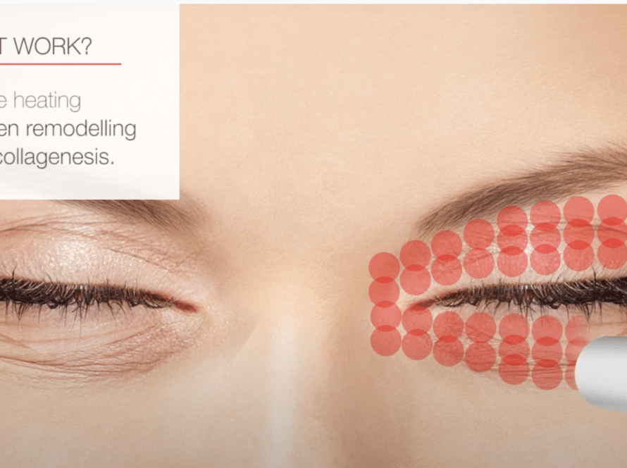 Fotona Smootheye treatment laser eye lid lift