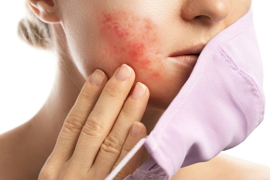 Maskne - acne breakouts from wearing a face mask