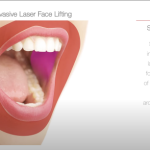 FOTONA 4D SKIN TIGHTENING STEPD