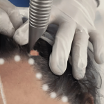 Fotona Vector Brow Lift - Image 3