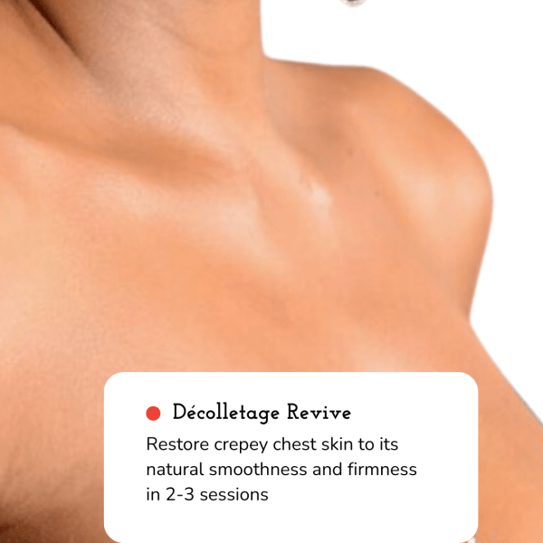 Fotona decolletage tightening