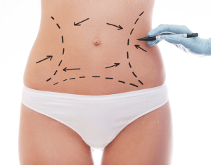 Smart Lipo e1773162942849 aesthetic medical spa treatment McLean VA En Santé Med