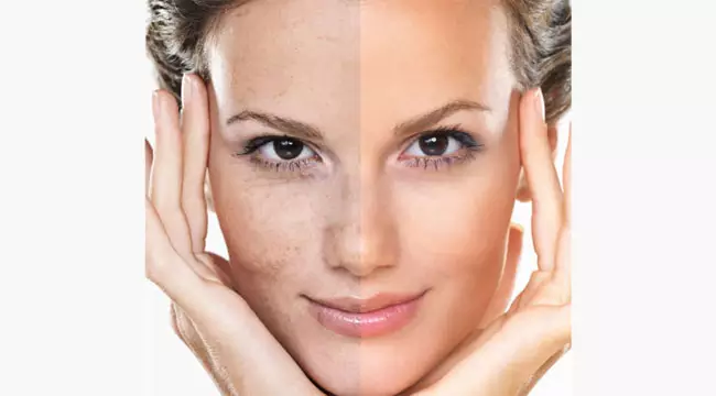 acne scars