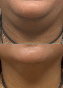 132 e1771788248565 aesthetic medical spa treatment McLean VA En Santé Med