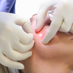 Stubborn fat and loose skin beneath the jawline can blur facial contours and make the lower face appear heavier or aged. At En Santé Med, Endolift® / EndoTight™ offers a powerful, minimally invasive laser solution to reduce fat, tighten skin, and redefine the jawline—without surgery, scars, or extended downtime. This advanced treatment delivers natural, progressive results using precision laser technology beneath the skin.