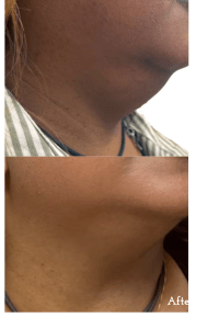 before and after chin and neck endolift aesthetic medical spa treatment McLean VA En Santé Med
