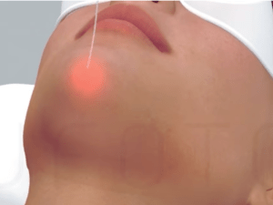 Endolifting laser aesthetic medical spa treatment McLean VA En Santé Med