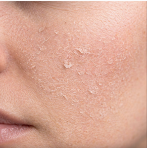 Common Side Effects After Acne Scar Treatment: 10 Essential Recovery Tips for Smoother, Healthier Skin 3