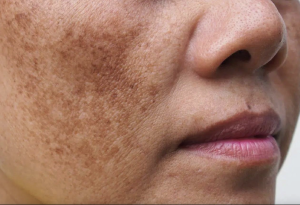 Common Side Effects After Acne Scar Treatment: 10 Essential Recovery Tips for Smoother, Healthier Skin 4