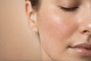 Common Side Effects After Acne Scar Treatment: 10 Essential Recovery Tips for Smoother, Healthier Skin 1
