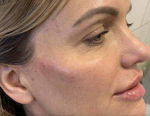 Common Side Effects After Acne Scar Treatment: 10 Essential Recovery Tips for Smoother, Healthier Skin 2
