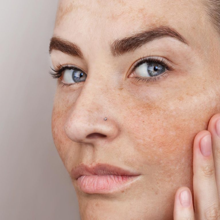 Melasma treatment in Northern Virginia