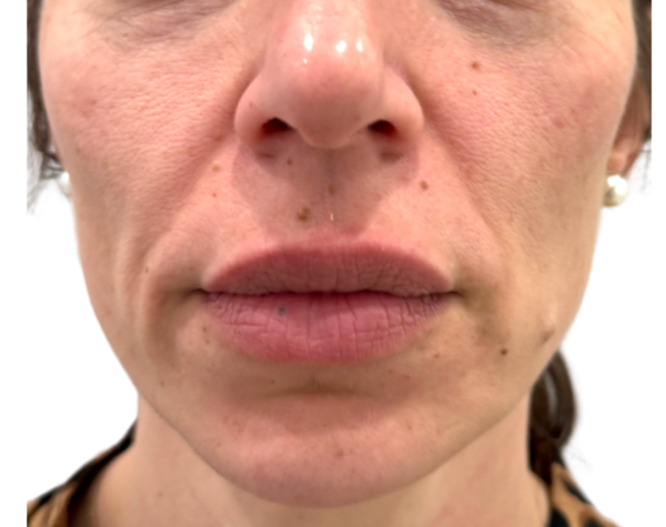 Laser face Lift Before